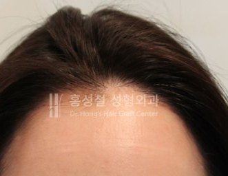 모발이식 전후 사진 — 헤어라인 (After)