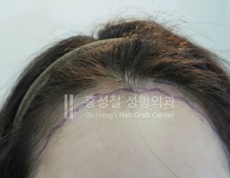 모발이식 전후 사진 — 헤어라인 (Before)