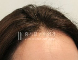 모발이식 전후 사진 — 헤어라인 (After)