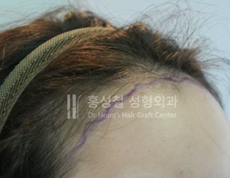 모발이식 전후 사진 — 헤어라인 (Before)