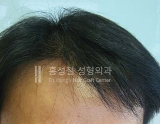 모발이식 전후 사진 (After)