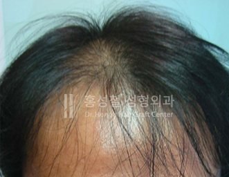 모발이식 전후 사진 (Before)