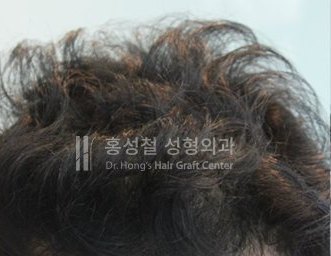 모발이식 전후 사진 (After)