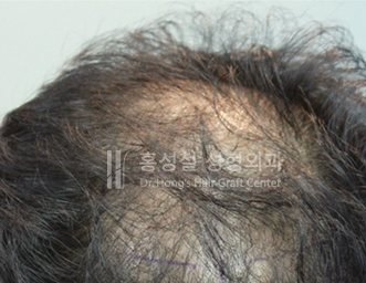 모발이식 전후 사진 (Before)