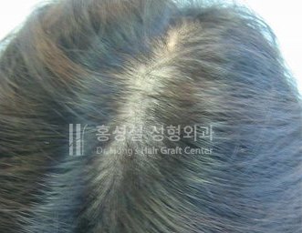 모발이식 전후 사진 — 정수리 (After)