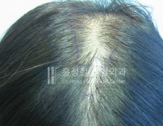 모발이식 전후 사진 — 정수리 (Before)
