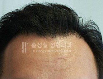 모발이식 전후 사진 — 헤어라인 (After)
