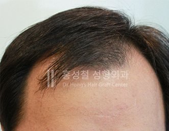모발이식 전후 사진 — 헤어라인 (Before)