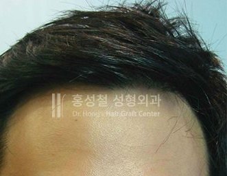 모발이식 전후 사진 — 헤어라인 (After)