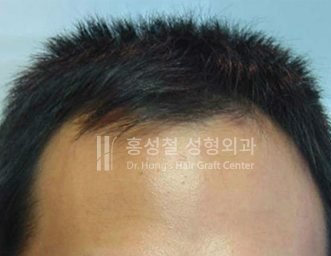 모발이식 전후 사진 — 헤어라인 (Before)