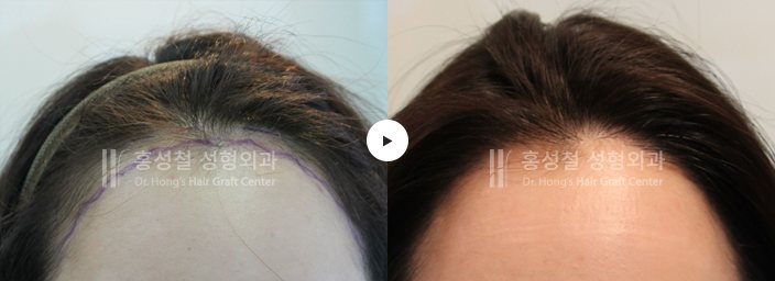 모발이식 전후 사진 — 헤어라인 (Before / After)