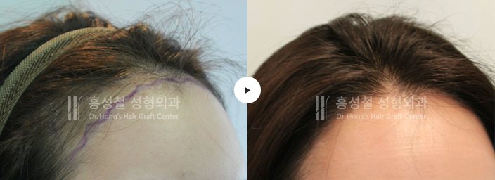 모발이식 전후 사진 — 헤어라인 (Before / After)
