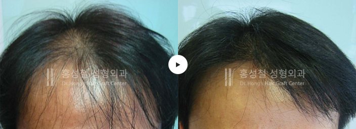 모발이식 전후 사진 (Before / After)