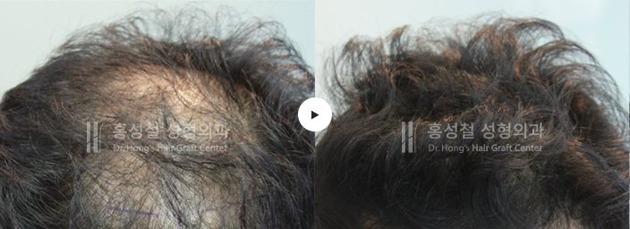 모발이식 전후 사진 (Before / After)