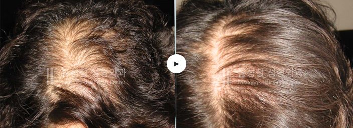 모발이식 전후 사진 — 정수리 (Before / After)