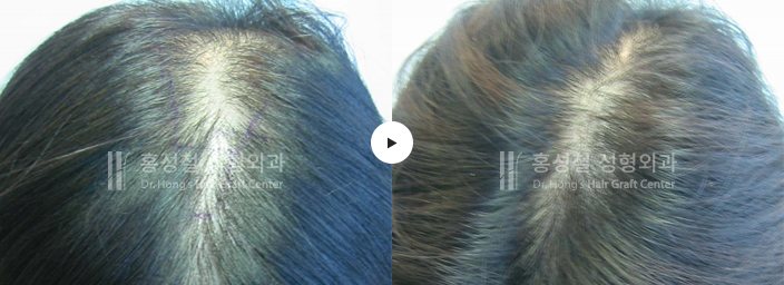 모발이식 전후 사진 — 정수리 (Before / After)