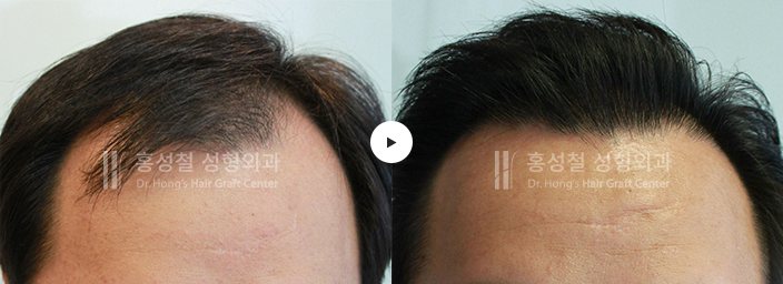 모발이식 전후 사진 — 헤어라인 (Before / After)