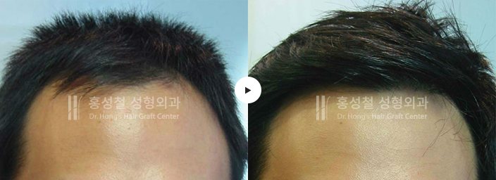 모발이식 전후 사진 — 헤어라인 (Before / After)