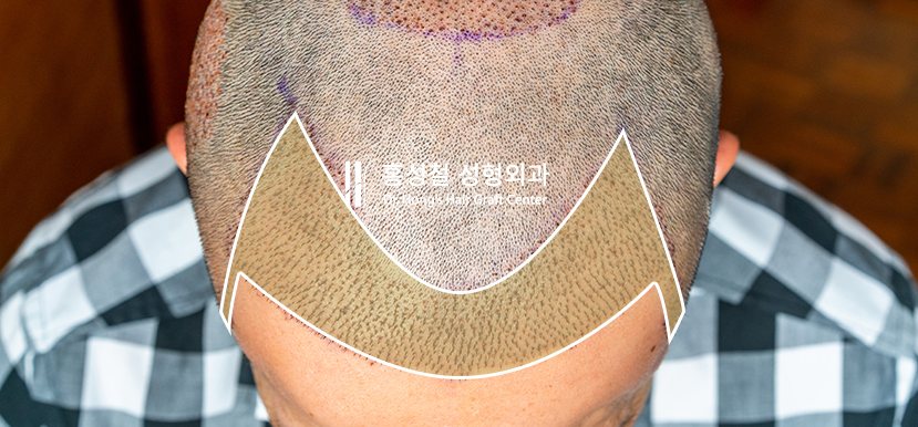 포워드 웨이팅 — 앞머리 쪽에 중점을 두어 이식하는 부위 표시