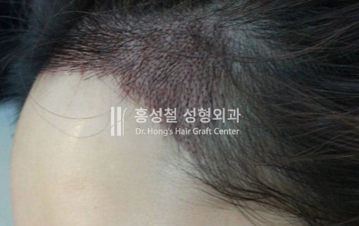 메가세션으로 이식한 헤어라인 부위 (측면)