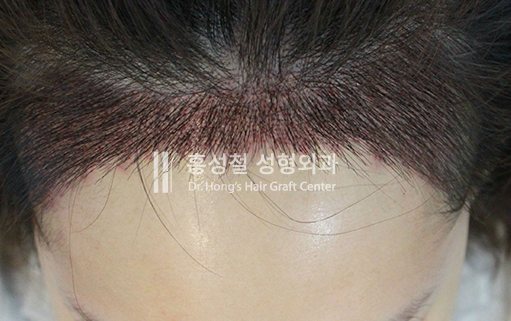 메가세션으로 이식한 헤어라인 부위 (정면)