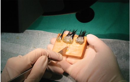 현미경 아래에서 분리된 모낭
